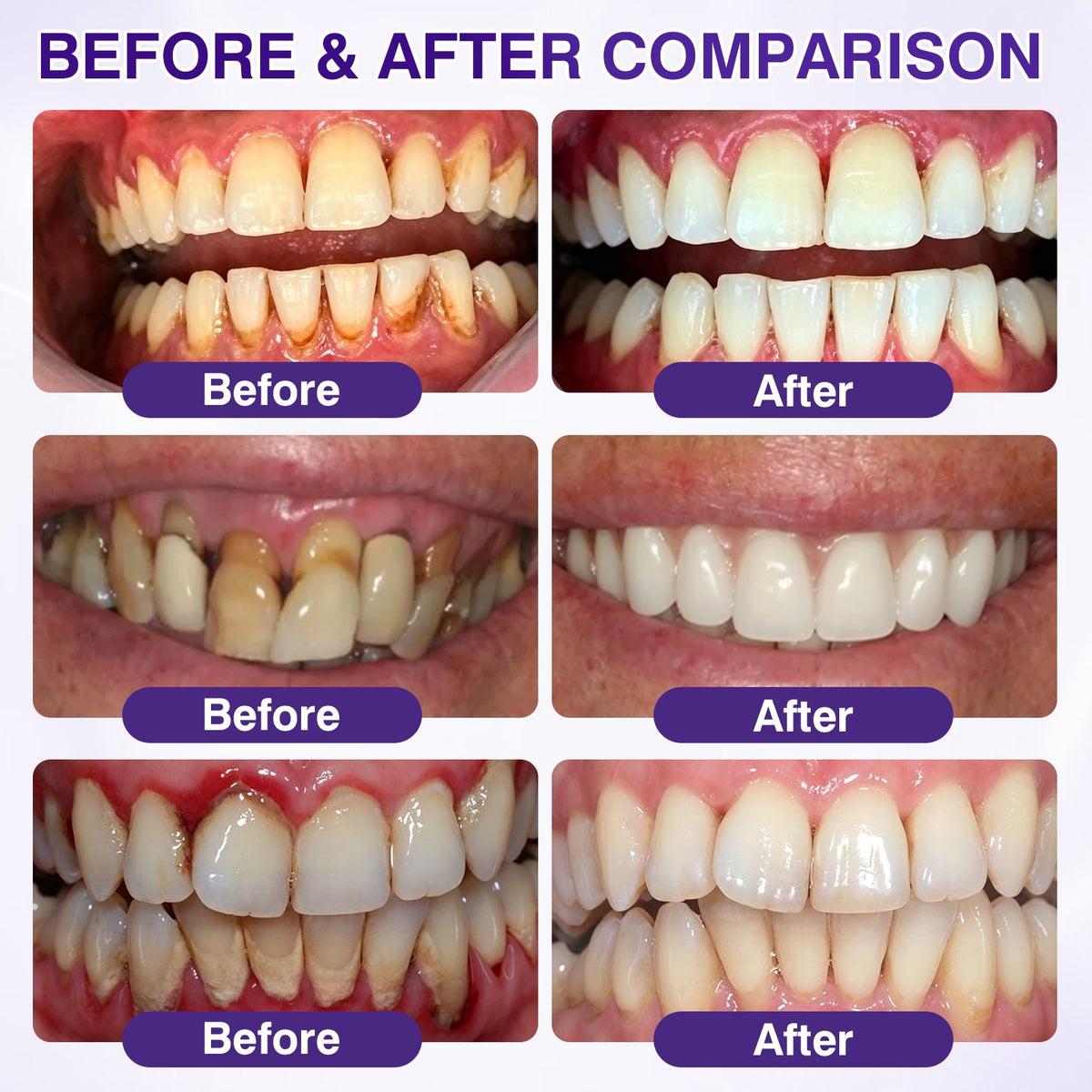 🇺🇸🎁🎁Evolvion® GumRevive Periodontal Repair Gel