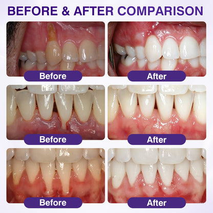 🇺🇸🎁🎁Evolvion® GumRevive Periodontal Repair Gel